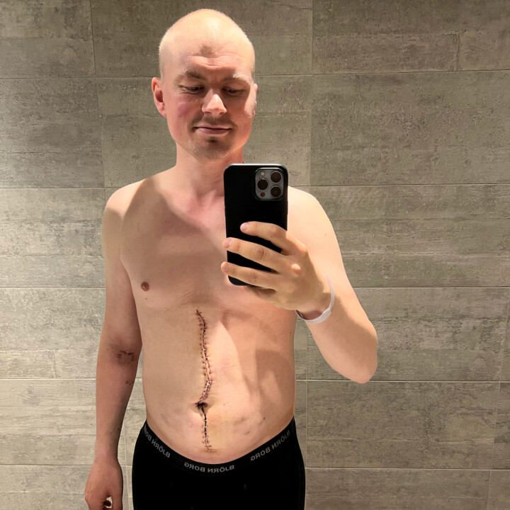 Hele magen til Østring ble delt opp og 28 lymfeknuter ble fjernet. I fire av dem ble det funnet kreft.